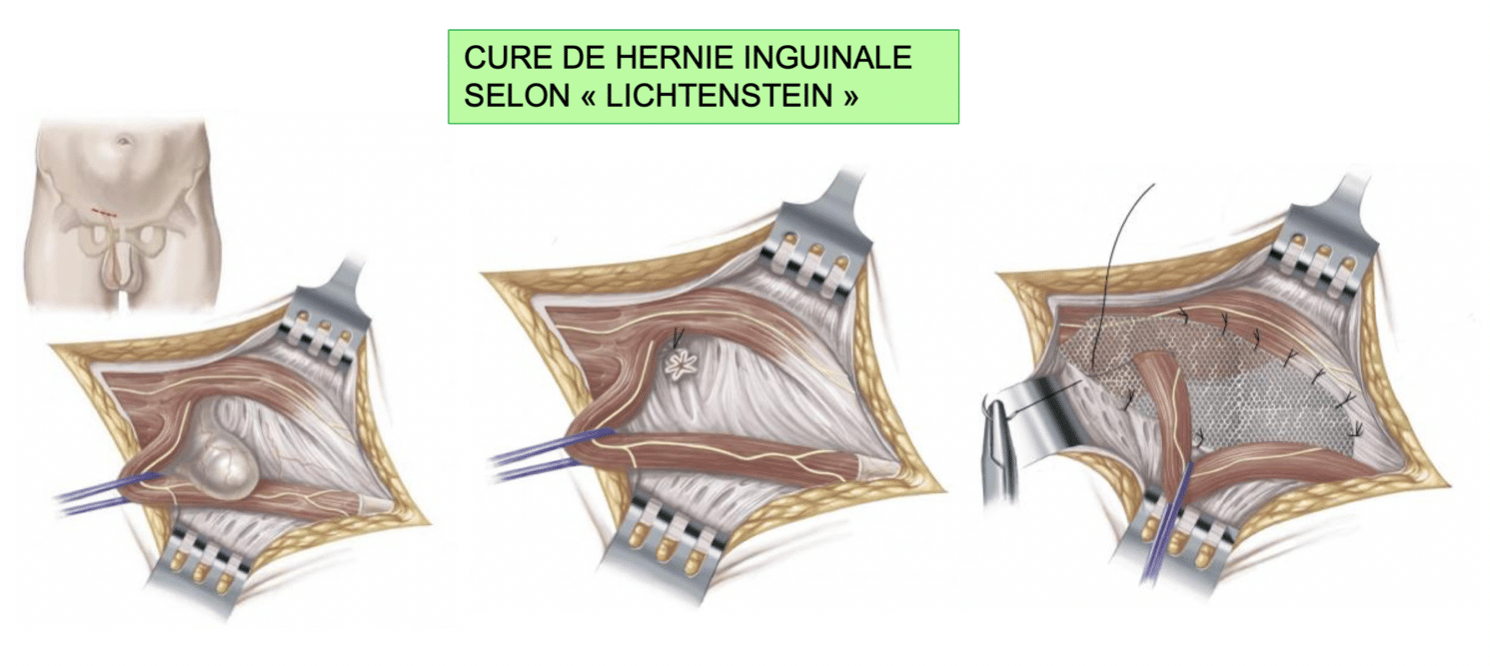 cure hernie inguinale